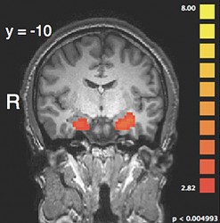 scan of brain with amygdala highlighted