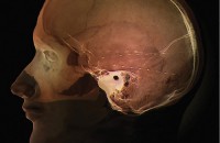 Brain Surgery through the Cheek