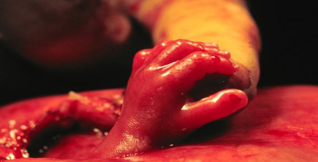 2011-02-fetalsurgery-650x332.jpg