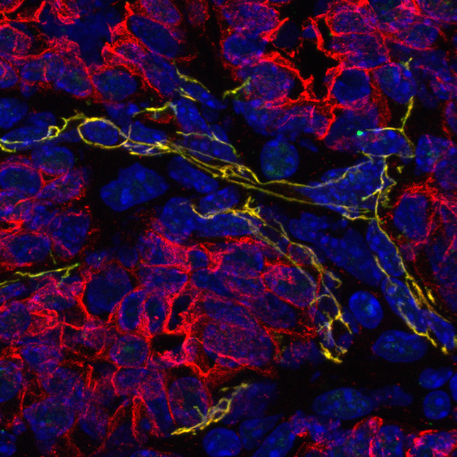 Softening tumor tissue could aid cancer treatments | VUMC Reporter