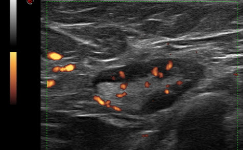 Power ultrasound, breast lesions